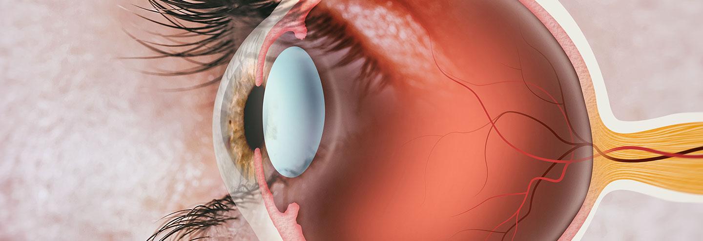 Transformative Early and Patient-Centric Treatments for Retinal Diseases