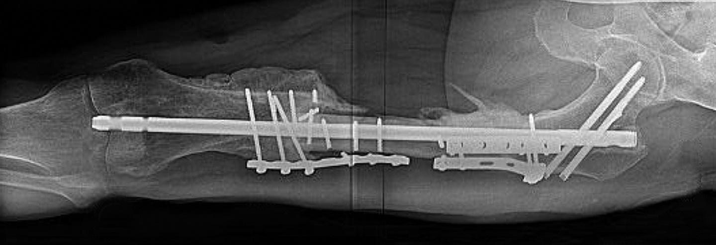 FDA Expands 510(k) Clearance for NuVasive’s Limb Lengthening Platform to Include Bone Transport