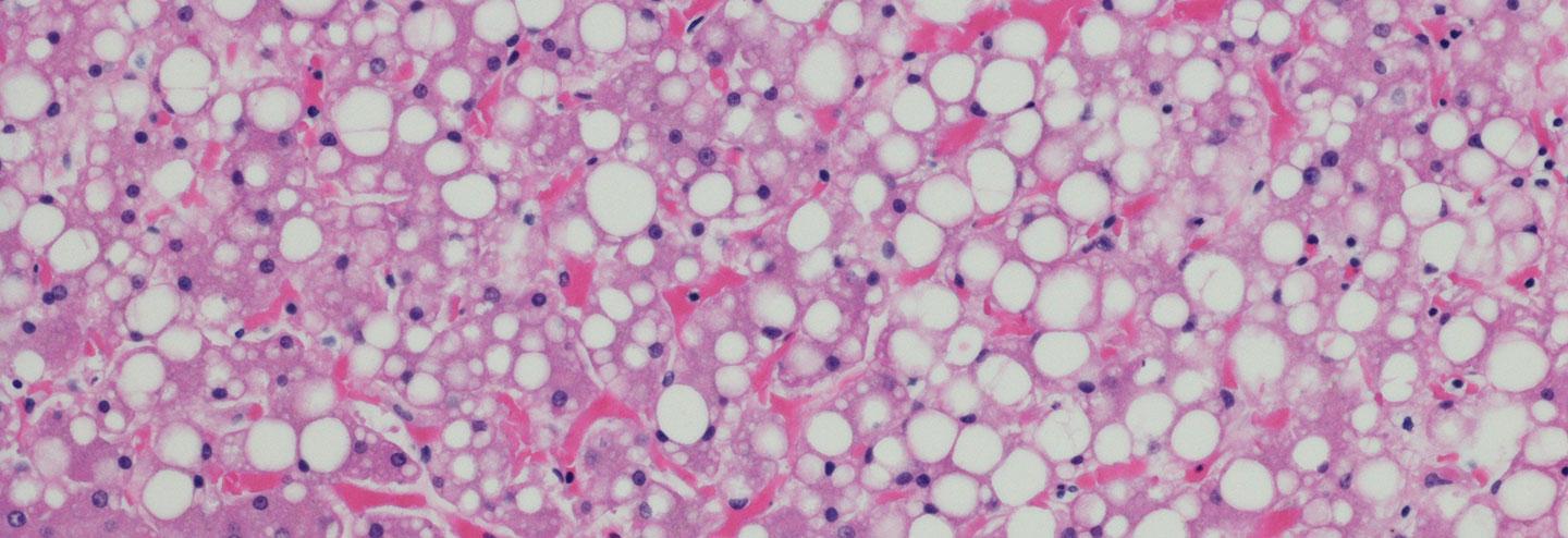Tackling Liver Disease with a Multimodal Cyclophilin Inhibitor