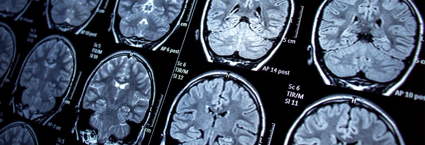Uncovering New Drug Targets for Neurological Diseases