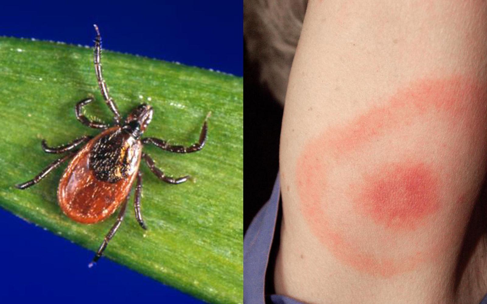 Emerging Lyme Disease Tests Found Efficacious