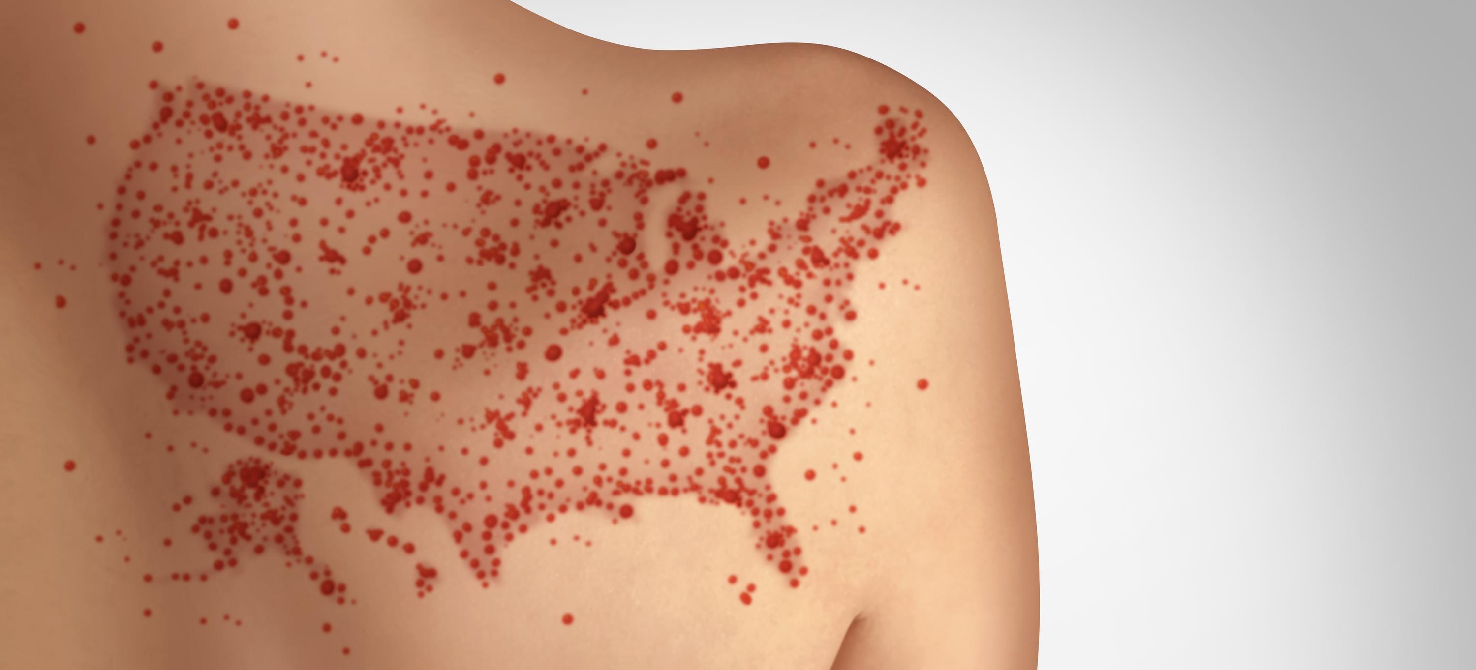 The 2025 Measles Crisis and the Fight for Public Health Trust