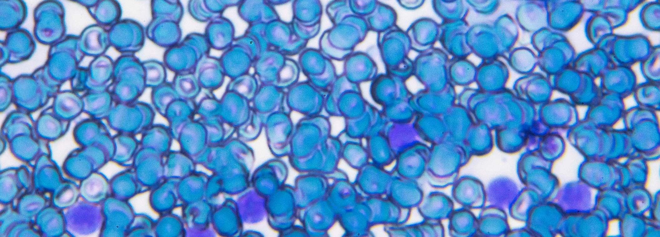 Therapeutic and Diagnostic Advances Benefiting Patients with Hematologic Malignancies